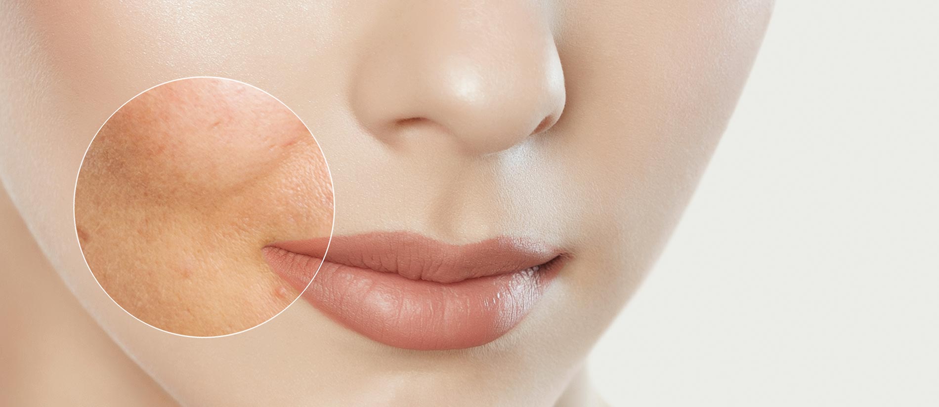 Zabiegi laserem frakcyjnym w Warszawie