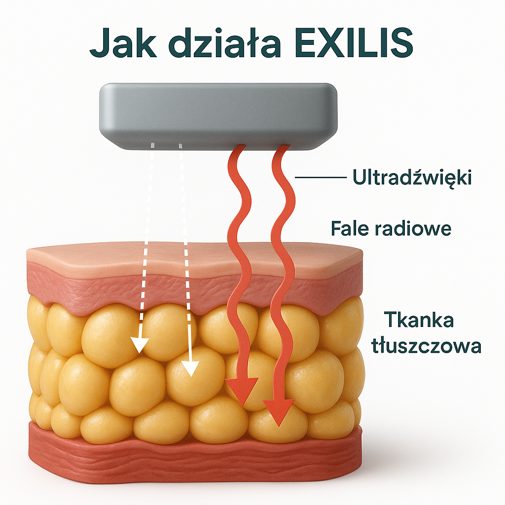 Exilis Elite w DKN Studio